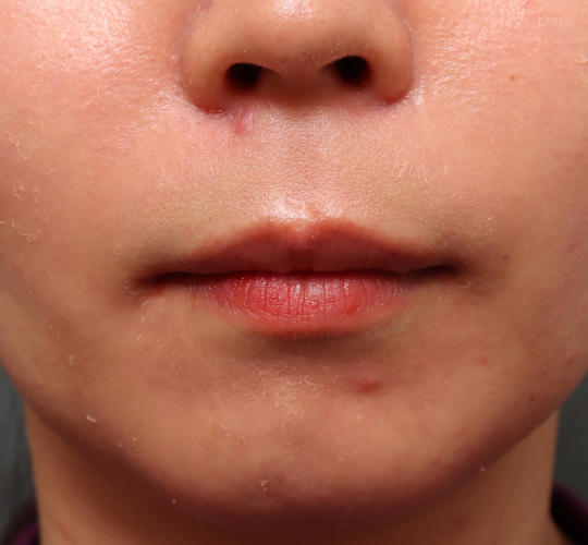 20代女性の人中短縮（リップリフト） Before 症例写真