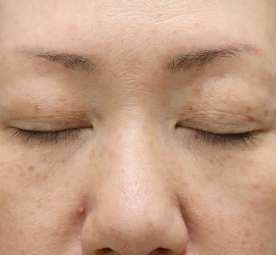 40代女性の真皮線維芽細胞療法 After 症例写真