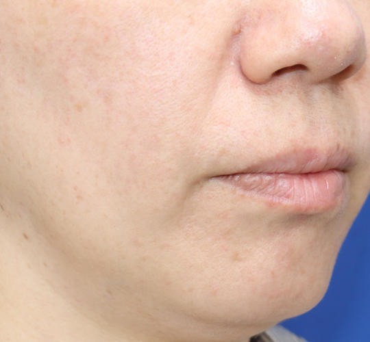 40代女性の真皮線維芽細胞療法 After 症例写真