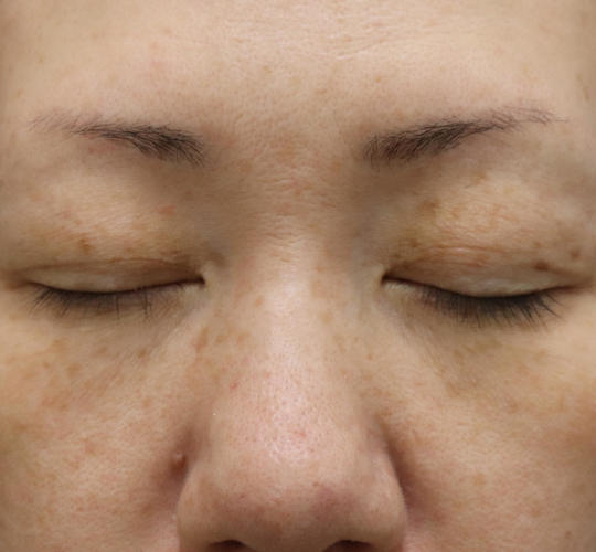 40代女性の真皮線維芽細胞療法 Before 症例写真