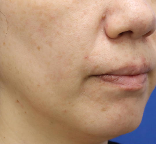 40代女性の真皮線維芽細胞療法 Before 症例写真