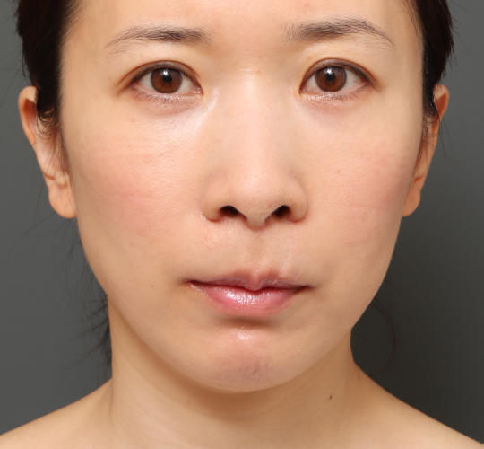 30代女性の3Dリポアイリフト  After 症例写真