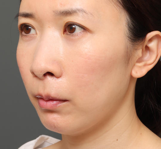 30代女性の3Dリポアイリフト  After 症例写真