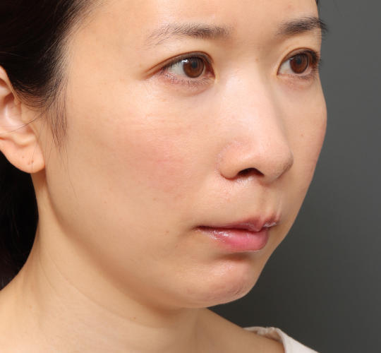 30代女性の3Dリポアイリフト  After 症例写真