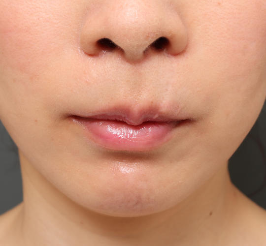 30代女性の3Dリポアイリフト  After 症例写真