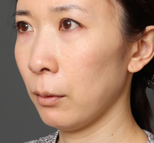 30代女性の3Dリポアイリフト  Before 症例写真