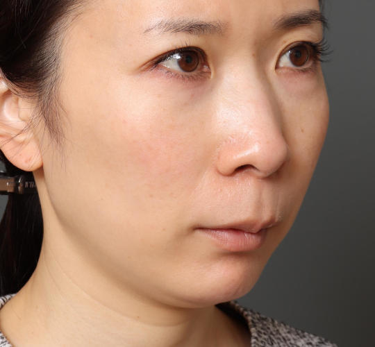 30代女性の3Dリポアイリフト  Before 症例写真