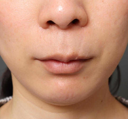 30代女性の3Dリポアイリフト  Before 症例写真