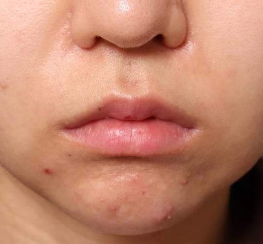 20代女性の人中短縮（リップリフト） Before 症例写真