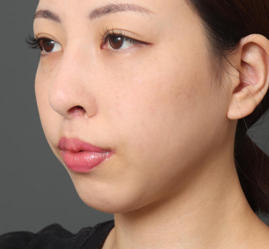 20代女性の顔の脂肪吸引  After 症例写真