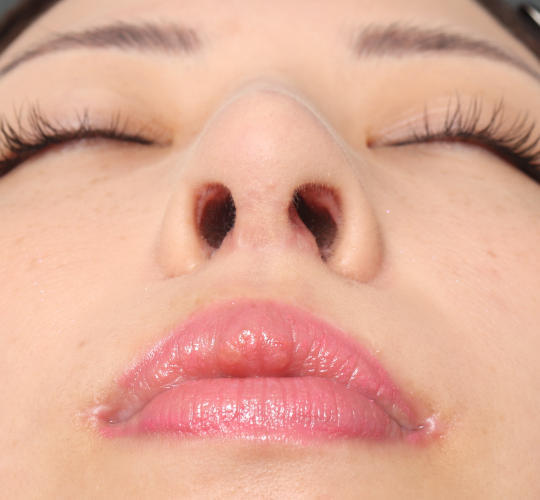 20代女性の顔の脂肪吸引  After 症例写真