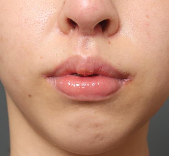 20代女性の顔の脂肪吸引  After 症例写真