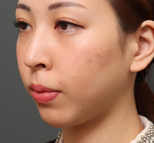 20代女性の顔の脂肪吸引  Before 症例写真