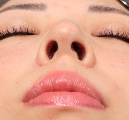 20代女性の顔の脂肪吸引  Before 症例写真