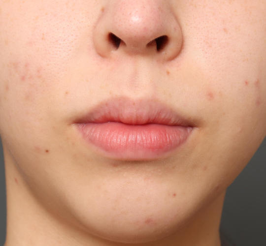 20代女性の顔の脂肪吸引  Before 症例写真