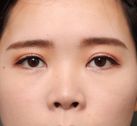 20代女性の目つき矯正 After 症例写真
