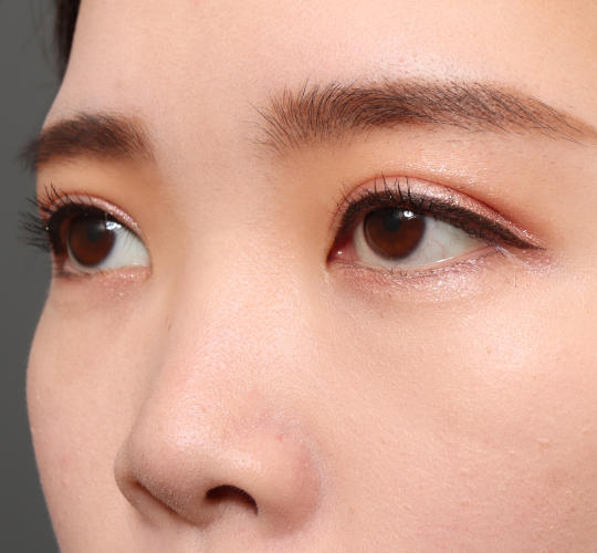 20代女性の目つき矯正 After 症例写真