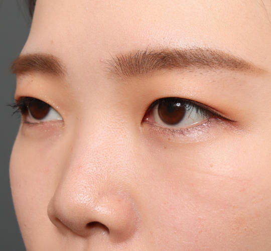 20代女性の目つき矯正 Before 症例写真