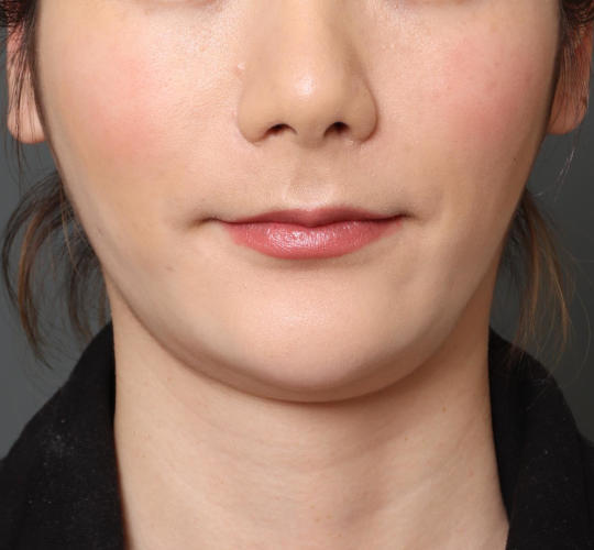 20代女性の顔の脂肪吸引  Before 症例写真