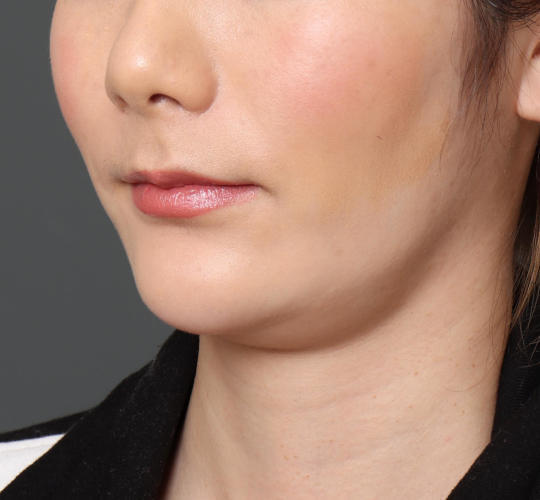 20代女性の顔の脂肪吸引  Before 症例写真