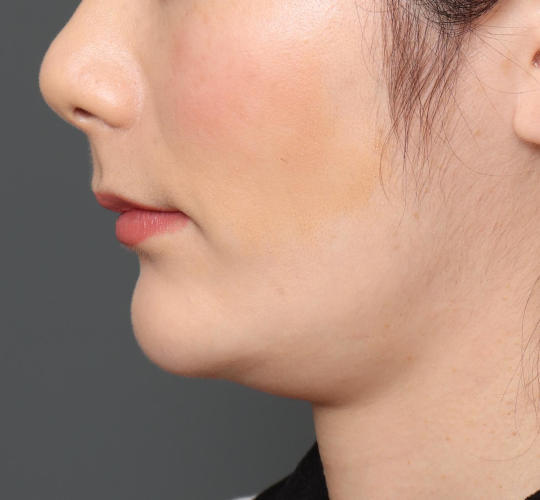 20代女性の顔の脂肪吸引  Before 症例写真