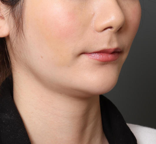20代女性の顔の脂肪吸引  Before 症例写真