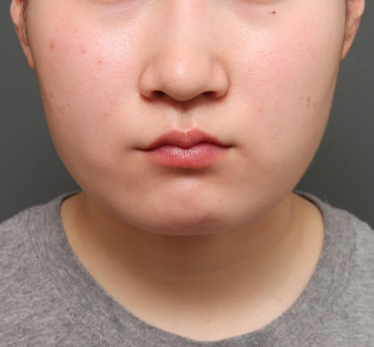 10代女性の顔の脂肪吸引 After 症例写真