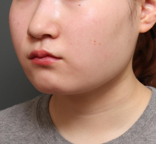 10代女性の顔の脂肪吸引  After 症例写真