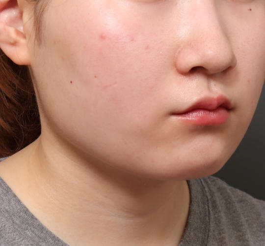 10代女性の顔の脂肪吸引  After 症例写真