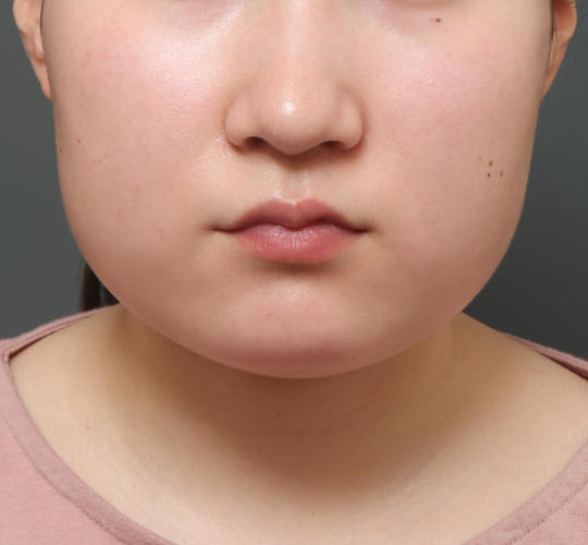 10代女性の顔の脂肪吸引 Before 症例写真