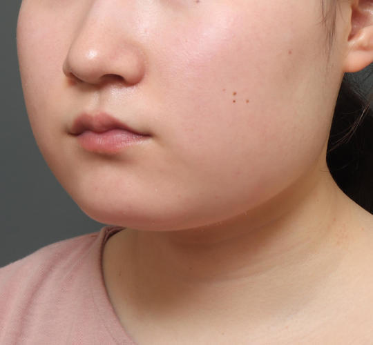 10代女性の顔の脂肪吸引  Before 症例写真