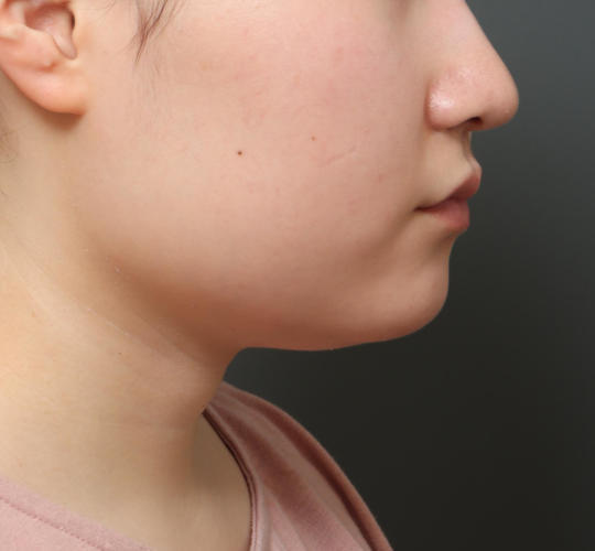 10代女性の顔の脂肪吸引  Before 症例写真