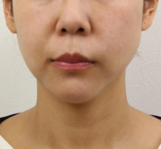 40代女性のVOVリフトプレミアム After 症例写真