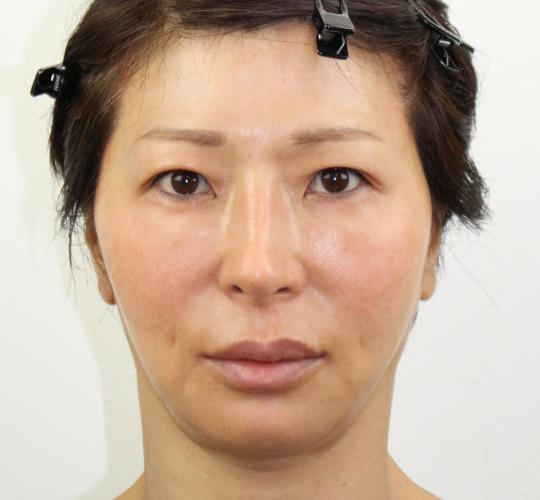 50代女性のVOVリフトプレミアム After 症例写真
