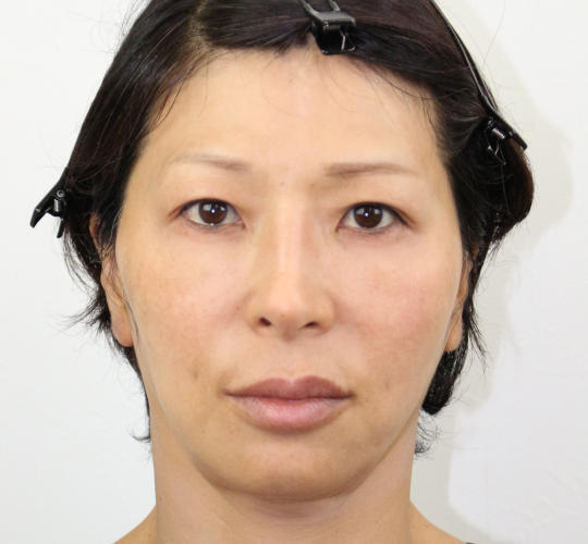 50代女性のVOVリフトプレミアム Before 症例写真