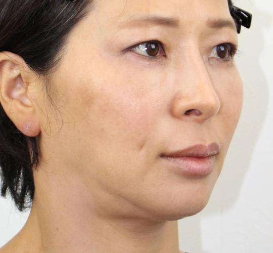 50代女性のVOVリフトプレミアム Before 症例写真