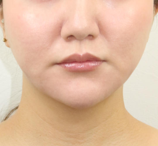 30代女性のVOVリフトプレミアム After 症例写真