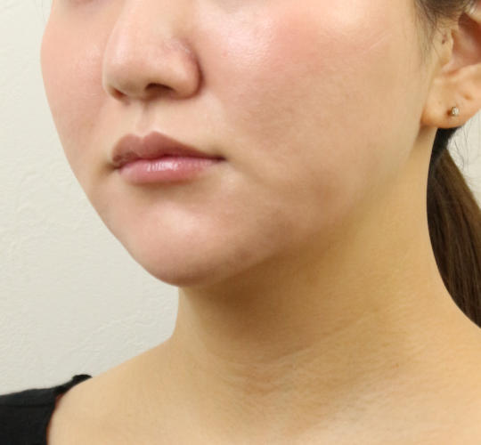 30代女性のVOVリフトプレミアム After 症例写真