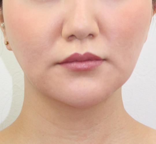 30代女性のVOVリフトプレミアム Before 症例写真