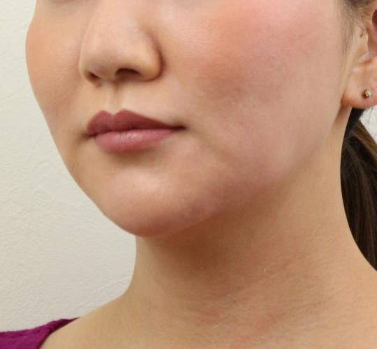 30代女性のVOVリフトプレミアム Before 症例写真