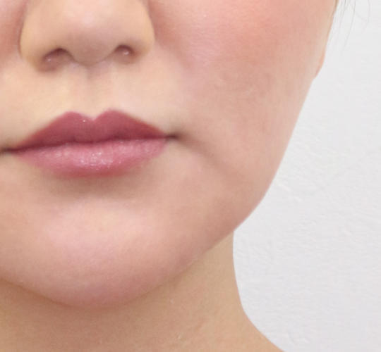 30代女性のVOVリフトプレミアム Before 症例写真