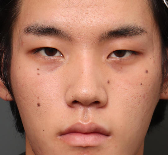 20代男性の目つき矯正 Before 症例写真