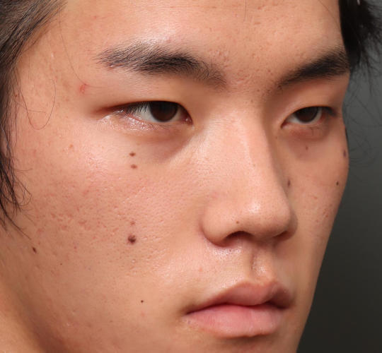 20代男性の目つき矯正 Before 症例写真