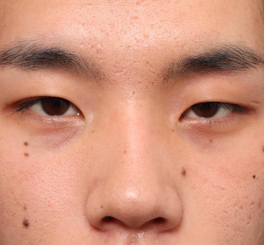 20代男性の目つき矯正 Before 症例写真