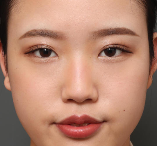 10代女性の目頭切開 Before 症例写真