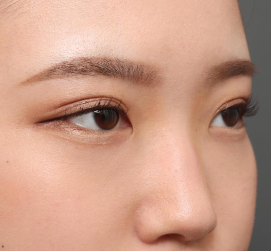 10代女性の目頭切開 Before 症例写真