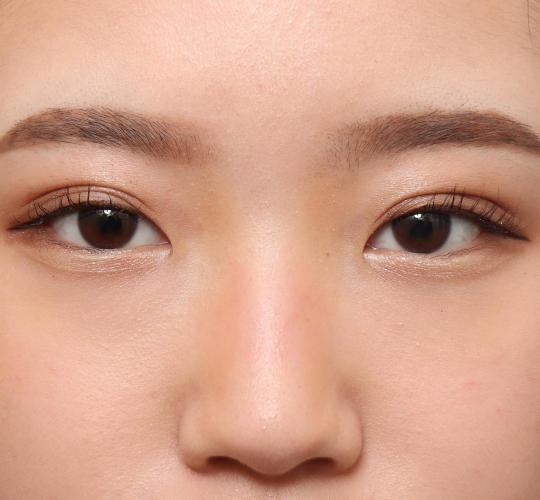 10代女性の目尻切開 Before 症例写真