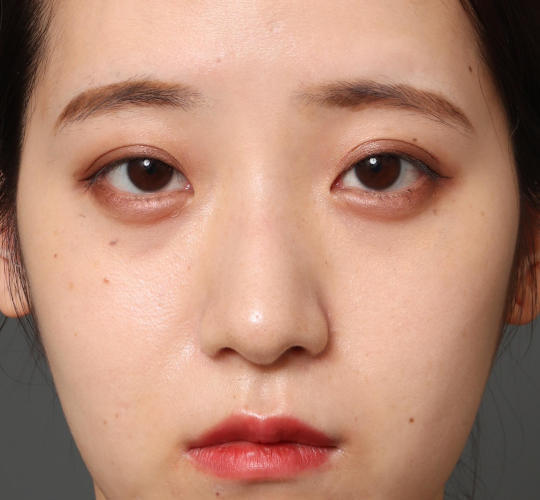 20代女性の目つき矯正 Before 症例写真