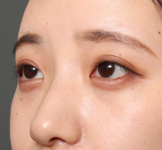 20代女性の目つき矯正 Before 症例写真