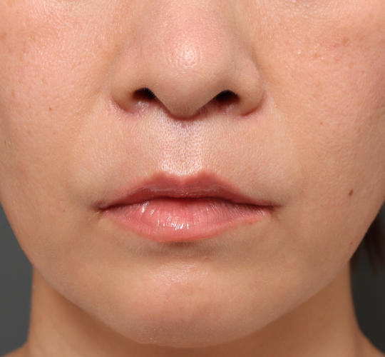40代女性の人中短縮（リップリフト） After 症例写真